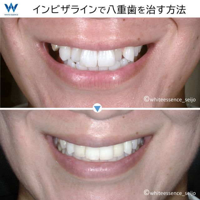 八重歯は、“歯の大きさ”と“顎の大きさ”のアンバランスが原因で起こる症状です。従来の治療方法では、歯を並べるスペースを確保するために抜歯が必要な場合が多くありました。ですが、インビザラインでは歯並びのアーチ形成を工夫し、歯の側面を微調整（０．５ｍｍ以内の範囲で形態修正）行う事により、抜歯をしなくても歯並びを治すことが可能になる場合が多いです。
 
 
Double teeth are caused by an imbalance between the size of the teeth and the size of the jaw. Conventional treatment methods often require tooth extraction to make place for the teeth. With Invisalign, however, it is possible to correct the alignment of teeth without tooth extraction.
 
 
#invisalign
#invisalignsmile
#インビザライン
#インビザライン矯正
#インビザライン矯正記録
#マウスピース矯正
#セラミック矯正
#裏側矯正
#矯正
#目立たない矯正
#見えない矯正
#歯列矯正
#矯正歯科
#矯正治療
#大人の矯正
#矯正日記
#歯並び
#出っ歯
#八重歯
#すきっ歯
#ガミースマイル
#Eライン
#横顔美人
#口ゴボ
#ダイエット
#白い歯
#ホワイトニング
#予防歯科
#矯正女子
#矯正女子と繋がりたい
#目立たない矯正
#見えない矯正