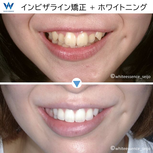 インビザライン矯正は、歯のホワイトニングが同時に行える画期的な矯正治療方法です。歯並びが良くなっても、歯が黄色いと口元がキレイに見えません。また、歯に黄ばみがあると、実年齢よりも上に見えてしまう事も多いです。
「ホワイトニングはいつから始めればいいですか？」というご質問をよく頂きますが、可能であれば矯正治療の初めからスタートするのが良いです。ホワイトニング剤にはプラークの抑制効果もあり、矯正中の虫歯予防効果があります。また、ステイン（着色汚れ）も付きにくくなります。マウスピースも薬の効果で清潔に保ちやすいです。
 
 
Invisalign orthodontic treatment is a revolutionary orthodontic treatment method that allows you to whiten your teeth at the same time. If your teeth are better aligned, but your mouth is not beautiful if your teeth are yellow. Yellow teeth make you look older.
We are often asked, “When should I start whitening my teeth?” If possible, it is best to start at the beginning of orthodontic treatment. Whitening gel also has a plaque inhibiting effect, which helps prevent cavities during orthodontic treatment. It also prevents stains from sticking to the teeth. The mouthpiece can also be kept clean.
 
We are a clinic specializing in making your mouth beautiful. We provide total support for the beauty and health of your mouth.