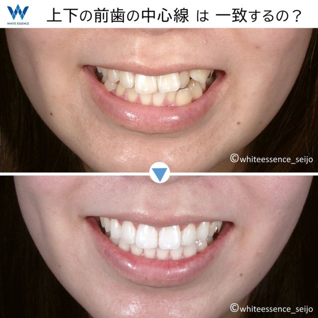 歯並びを矯正する際、前歯の中心線のズレをどうするか？・・・歯科医が非常に悩む点です。中心線を一致させて欲しいと要望される方も多々いらっしゃるので、まずは一致させるような治療設計を行います。ですが、どうしても骨格に左右差があったり、上顎の位置と下顎の位置が生まれつきズレている方は、外科手術が必要となるため治療のハードルが上がります。外科手術がNGの場合、複数の歯と歯の間を大きく削りスペースを確保して調整する方法もありますが、これにも限界があります。図での説明のとおり、学問上では下の前歯の半分以内に収まる場合は許容範囲とされています。生体構造を踏まえた上で許容範囲内に収めるか、外科処置や歯の切削なども併用して一致させることを優先するかは、担当医とご相談の上決定して頂くことをおススメします。

※この方は骨格のズレが大きくなかったので、インビザライン矯正のみでほぼ一致できました。

※歯のホワイトニングも同時に行っております。

#invisalign
#invisalignsmile
#orthodontics
#インビザライン
#インビザライン矯正
#マウスピース矯正
#セラミック矯正
#裏側矯正
#矯正
#目立たない矯正
#見えない矯正
#歯列矯正
#矯正歯科
#矯正治療
#大人の矯正
#矯正日記
#歯並び
#出っ歯
#叢生
#八重歯
#すきっ歯
#受け口
#ガミースマイル
#Eライン
#横顔美人
#口ゴボ
#ダイエット
#白い歯
#ホワイトニング
#矯正女子