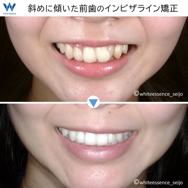 前歯が横方向に傾斜している場合、顔の中心線と歯の中心線の軸が大きくズレるため非常に目立ちます。このような傾斜は、アタッチメントとう補助装置を使うと効果的に回転力が働き歯の移動が早まるため、日頃から治療の中で頻繁に用います。歯並びの症状は人によって千差万別ですので、同じインビザラインでも様々なテクニックを組み合わせて治療を行っております。
 
※歯のホワイトニングを同時に行っております。
 
If your front teeth are tilted to the side, it is very noticeable because the centerline of your face and the centerline of your teeth are very misaligned. This symptom can be treated quickly with attachments. Since the symptoms of teeth alignment vary from person to person, we will use a combination of different techniques to treat your condition.
 
*This patient had teeth whitening done at the same time.
 
#invisalign
#invisalignsmile
#orthodontics
#インビザライン
#インビザライン矯正
#インビザライン矯正記録
#マウスピース矯正
#セラミック矯正
#裏側矯正
#矯正
#目立たない矯正
#見えない矯正
#歯列矯正
#矯正歯科
#矯正治療
#大人の矯正
#矯正日記
#歯並び
#出っ歯
#八重歯
#すきっ歯
#ガミースマイル
#Eライン
#横顔美人
#口ゴボ
#ダイエット
#白い歯
#ホワイトニング
#予防歯科
#ワイヤー矯正