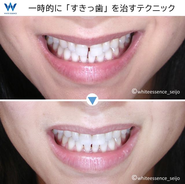 すきっ歯の改善には矯正治療が一番効果的なのですが、治療期間が長くかかってしまうことがネックとなります。
この画像の方は１か月後にある挙式までに、なんとかキレイに見えるよう改善をして欲しいとのご要望でした。非常に短い期間でしたので、まず①黄ばんだ歯のホワイトニングを行い、②その後に一番目立つ上前歯の「すきっ歯」をダイレクトボンディング法で閉鎖する治療法を行いました。ダイレクトボンディング法は本来、小さな虫歯を削った部分を特殊な樹脂で目だたなく治す治療法ですが、それを応用して歯の側面の形態を変え、すき間部分を閉鎖しました。ただ、このダイレクトボンディング法に使用する樹脂は強度がそれほど高いわけではないので、すきっ歯の「一時的な改善法」とお考え下さい。
 
Orthodontic treatment is the best way to improve voided dentition. However, orthodontic treatment takes a long time.
This patient had a wedding scheduled in one month. She wanted to improve her dental problems before her wedding. We first whitened her teeth and then performed a direct bonding procedure to correct the gap in her teeth. The resin used for direct bonding is not very strong and should be considered a “temporary fix” for a gap in the teeth.
 
#invisalign
#invisalignsmile
#インビザライン
#インビザライン矯正
#インビザライン矯正記録
#マウスピース矯正
#セラミック矯正
#裏側矯正
#矯正
#目立たない矯正
#見えない矯正
#歯列矯正
#矯正歯科
#矯正治療
#大人の矯正
#矯正日記
#歯並び
#出っ歯
#八重歯
#すきっ歯
#ガミースマイル
#Eライン
#横顔美人
#口ゴボ
#ダイエット
#白い歯
#ホワイトニング
#予防歯科
#矯正女子
#笑顔
#目立たない矯正
#見えない矯正